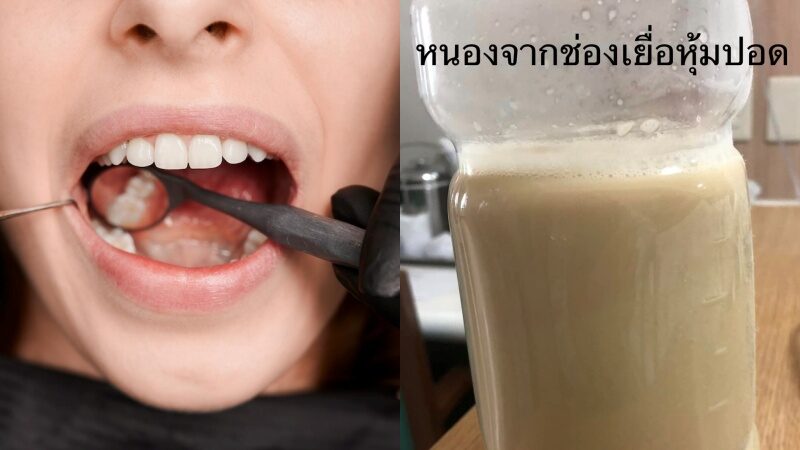 ฟันผุหนอง 02 ฟันผุหนอง 02